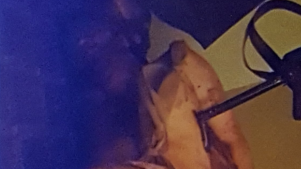 صورة لا تحتمل.. “هكذا عذبني الحوثي حتى أصبت بالشلل”